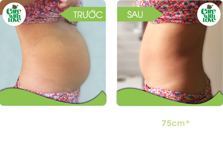 Chị Dung, Toàn diện sau sinh 20 buổi